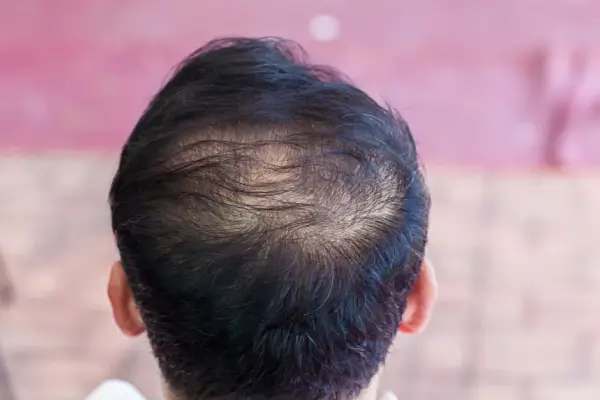 Hair Thinning