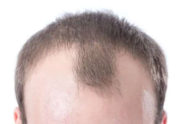 Receding Hairline