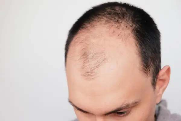 Genetic Hair Loss