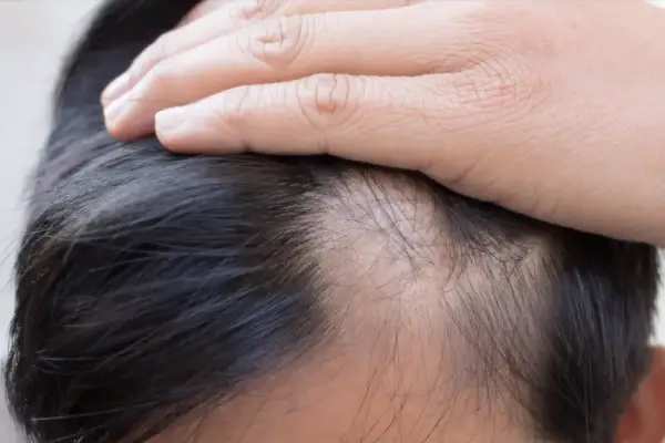 Alopecia Areata